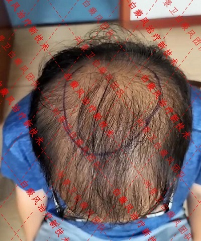 海南治疗脱发正规医院 男性头顶脱发的主要原因和治疗方法