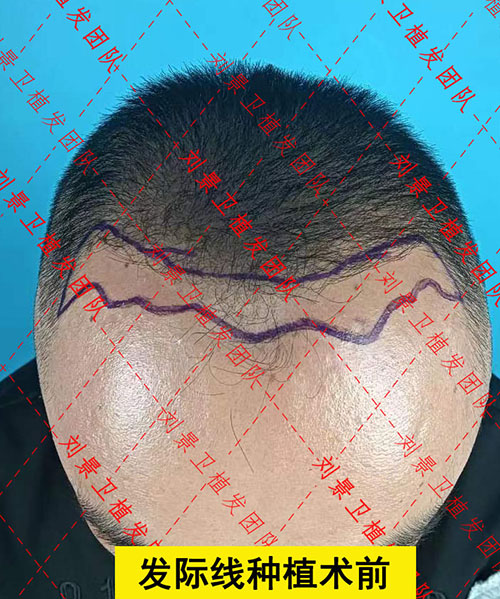 海口皮肤科医院科普：不剃发植发和剃发植发的优缺点对比