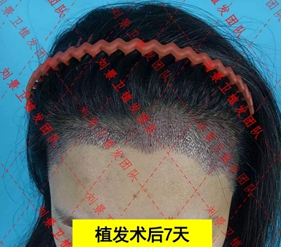 海南植发知名专家 如何保持植发后的头发不掉落？