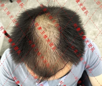 海南专业毛发医院 头发一天不洗就油腻且大量脱发是什么原因？