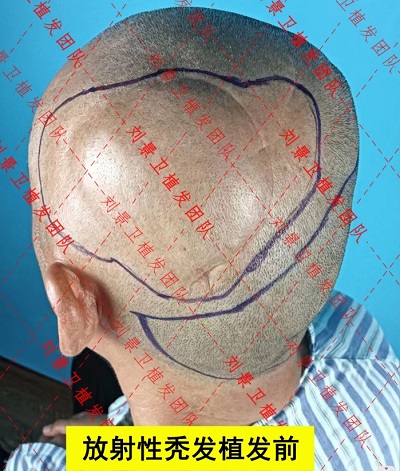 海南正规植发医院 放射性秃发可以通过植发来治疗吗？